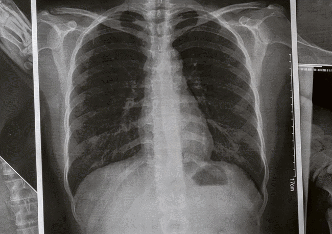 12 dấu hiệu chứng tỏ 2 lá phổi đang kêu cứu