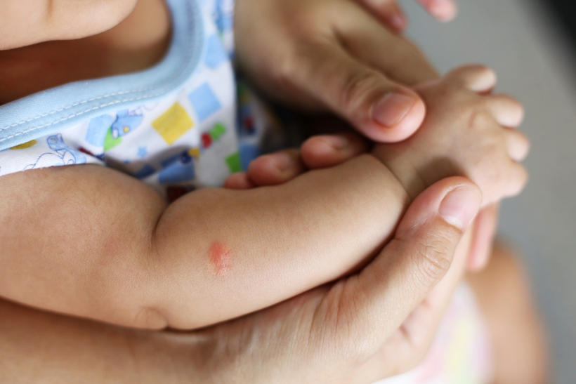 Trẻ sơ sinh mắc SXH có thể xuất hiện dấu hiệu xuất huyết dưới da, bụng, tay, chân, cổ, hay mí mắt. Ảnh minh họa.