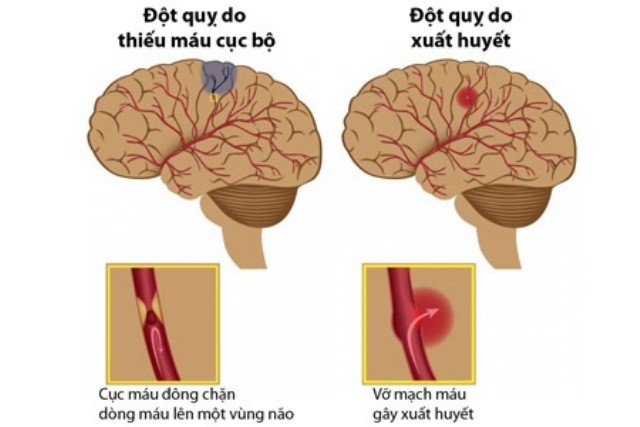 Nguyên nhân gây đột quỵ là do sự bất ổn của tuần hoàn máu não. Nguồn: Bệnh viện Đa khoa tỉnh Lạng Sơn.