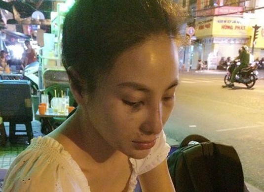 Lại thêm Hoa hậu Việt bị bạn trai đánh đập tàn nhẫn
