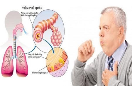 Cách kiểm soát biến chứng của bệnh phổi tắc nghẽn mạn tính