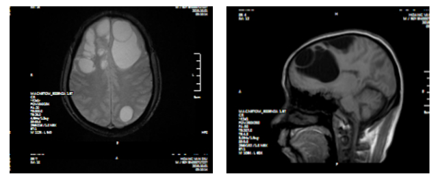 Hình ảnh CT, MRI sọ não kén sán não trước mổ (BVCC).