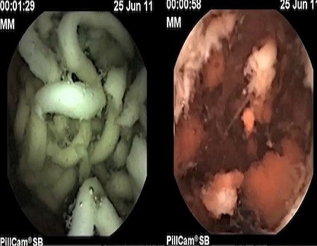 Hình ảnh mỳ ăn liền (trái) vẫn "nguyên hình" sau nhiều giờ nằm trong dạ dày.