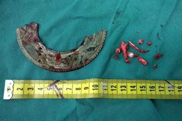 Lưỡi cưa và những mảnh xương sọ bị vỡ của Zheng Lang