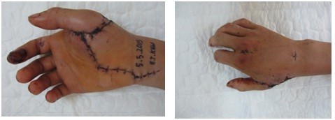 Bàn tay anh K. 10 ngày sau phẫu thuật đã có thể cử động nhẹ
