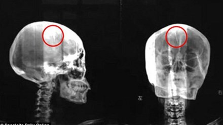 Phim chụp cắt lớp cho thấy một vật nhọn, dài khoảng 5cm, nằm trong hộp sọ của bệnh nhân.