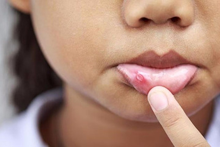 6 cách tự nhiên chữa lở miệng