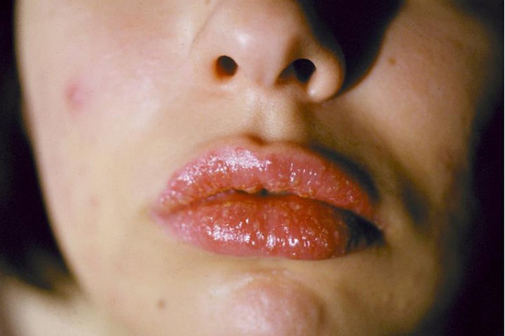 Triệu chứng và cách xử lý khi bị nhiễm độc chì từ son môi