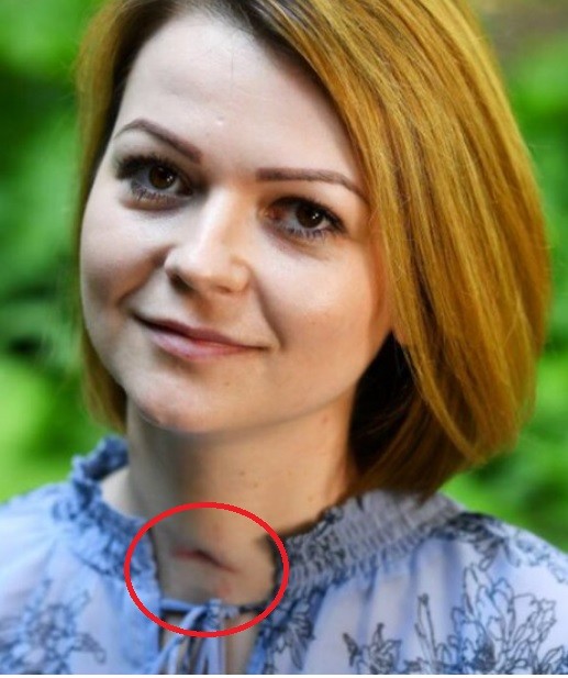 Mạng xã hội xôn xao vì vết sẹo lạ trên cổ con gái cựu điệp viên Skripal