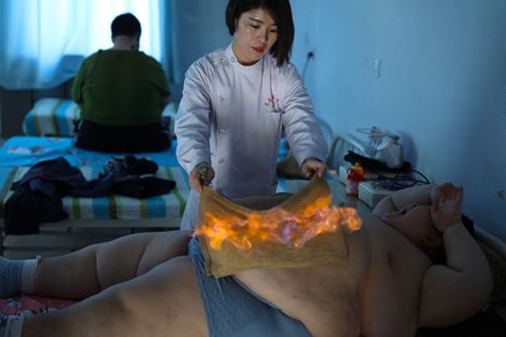 Dùng lửa đốt mỡ bụng, phương pháp giảm cân cho nhiều trẻ em béo phì tại Trung Quốc