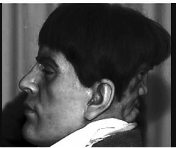 Đầu bằng sáp mô tả hai khuôn mặt của Edward Mordake do một họa sĩ thể hiện. 