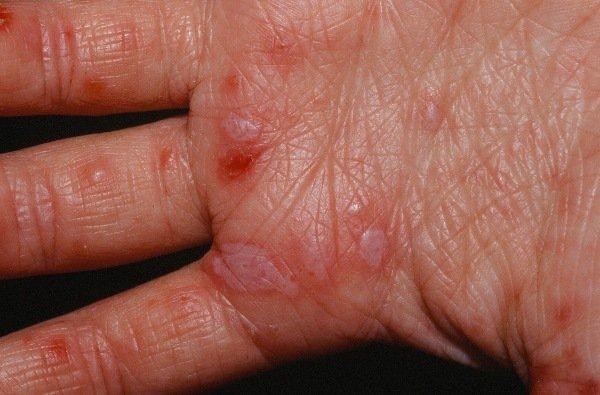 Những nốt ban của tay chân miệng thường dát sẩn, chìm ở bề mặt da.