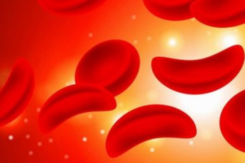 Thiếu máu hồng cầu hình liềm là một bệnh thiếu máu di truyền.