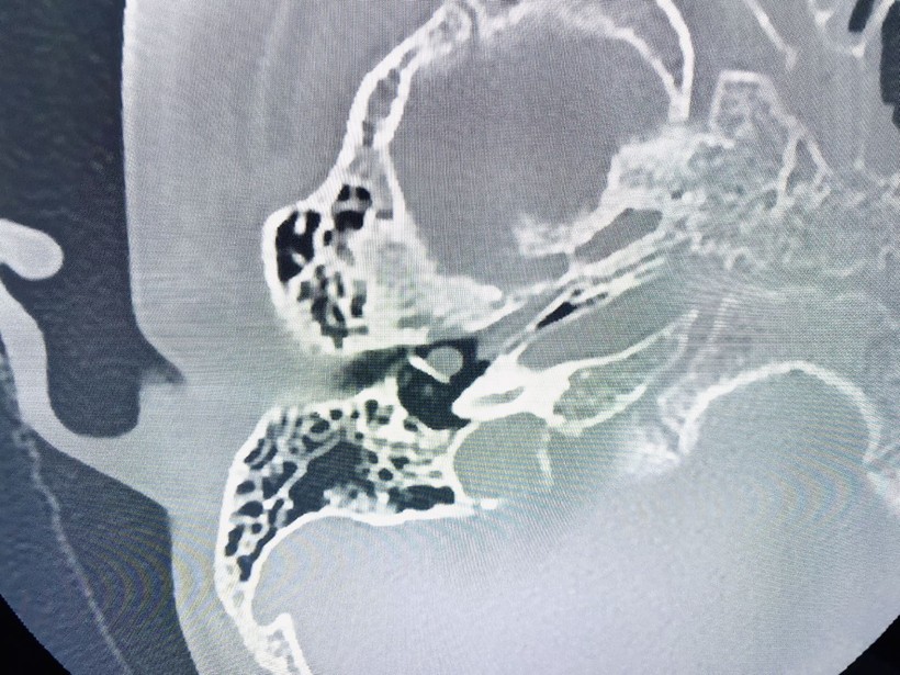 Hình ảnh khối u tai của bệnh nhi 5 tuổi trên phim chụp cắt lớp vi tính. (Ảnh: BVCC)