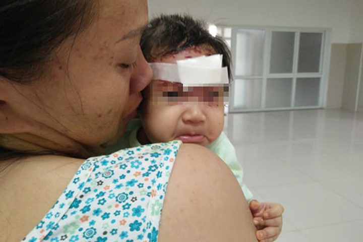 Bé gái 2 tháng tuổi bị khỉ cào rách mặt