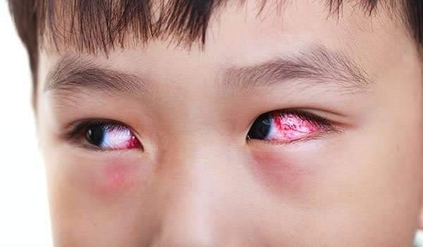 Dịch đau mắt đỏ ở Thừa Thiên - Huế đang tăng nhanh trong khối học sinh. (Ảnh: minh họa).