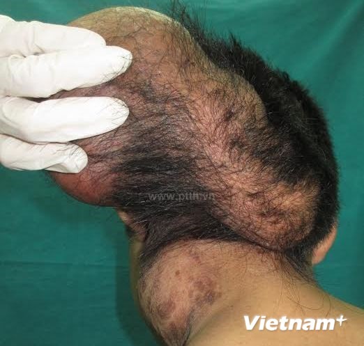 Khối u của bệnh nhân trước khi phẫu thuật. Ảnh: PV/Vietnam+