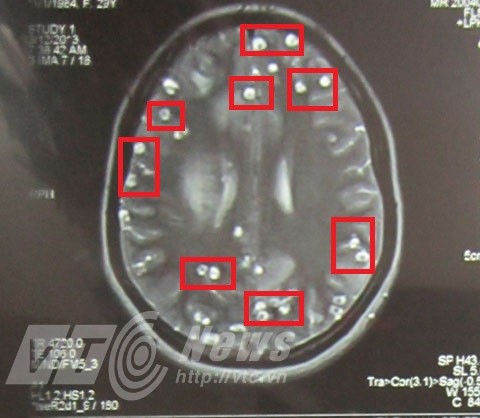 Những nốt tròn trong có nhân là nang sán lợn làm tổ dày đặc trong não chị H. (Ảnh: BS Thọ cung cấp) 