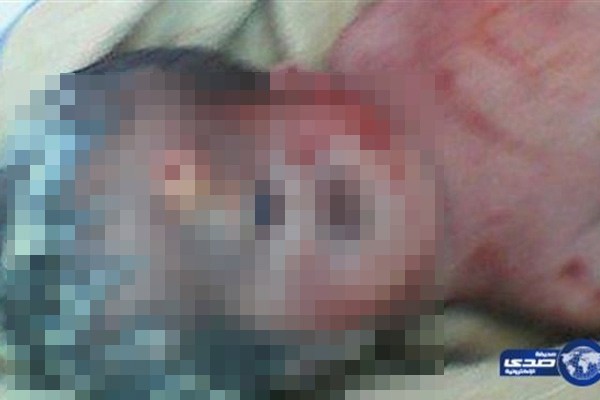 Em bé đáng thương sinh ra chỉ có một mắt và mũi trên trán