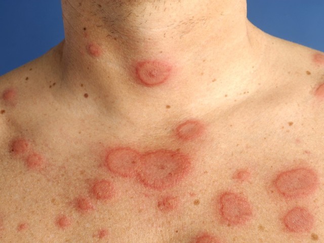 5 dấu hiệu ở da tố bạn dị ứng thuốc