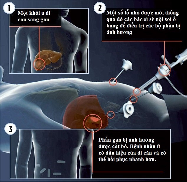Chìa khóa ngăn ung thư đại tràng tấn công gan