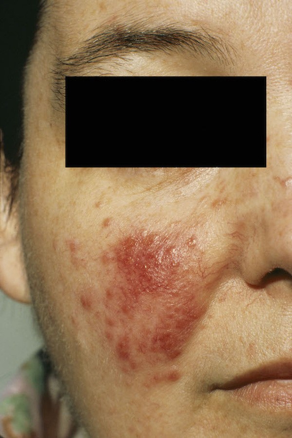 Cảnh báo 8 dấu hiệu ở da là triệu chứng của những bệnh cực nguy hiểm