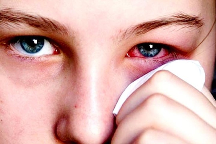 Cân nhắc chế độ ăn uống là việc rất cần thiết cho người điều trị đau mắt đỏ