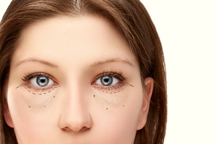 Bọng mắt xuất hiện chủ yếu do di truyền.