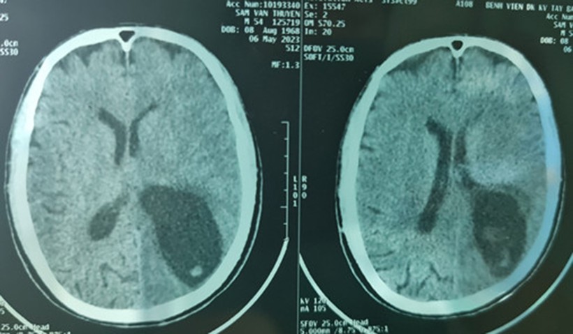 Hình ảnh phim chụp cắt lớp sọ não bệnh nhân S.V.T. trước khi phẫu thuật. (Ảnh: BVCC)