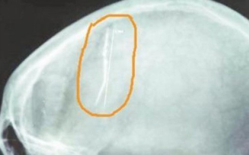 Hình ảnh trên phim chụp cho thấycây kim ở trong đầu bệnh nhân. Ảnh:SCMP

