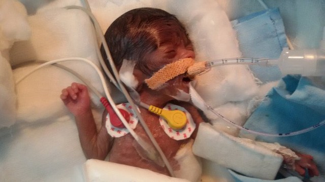 Em bé “bé nhất hành tinh” được phẫu thuật tim thành công 