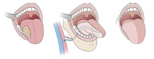 Nhiệt miệng mãi không khỏi, đi khám phải cắt 1/2 lưỡi: cách phân biệt ung thư và nhiệt miệng