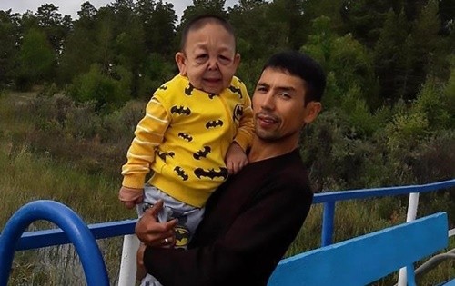 Căn bệnh hiếm khiến cậu bé 6 tuổi Kazakhstan trông như ông lão
