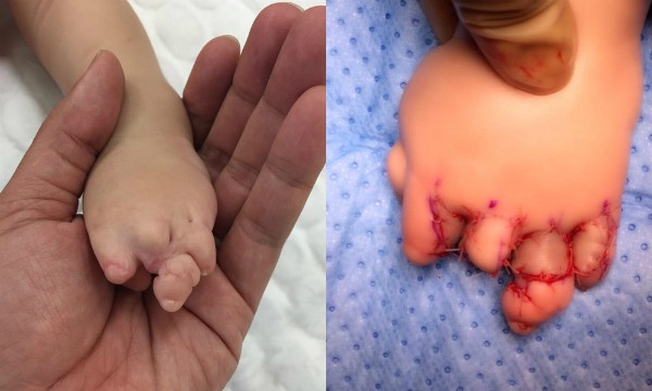 Hội chứng bẩm sinh hiếm gặp khiến bé gái dính ngón tay, chân