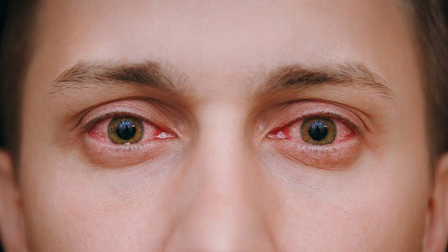 Làm gì khi có hiện tượng đỏ mắt? 