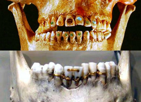 Trồng răng sửa mũi thời cổ đại được thực hiện như thế nào