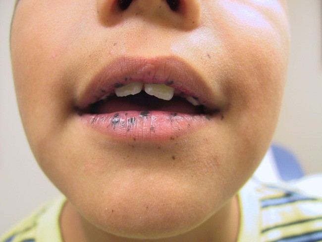 Trẻ đau bụng, có vết đen lạ trên môi: Coi chừng con mắc hội chứng nguy hiểm
