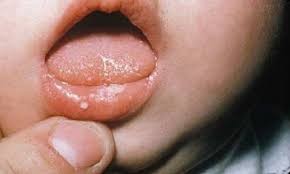 Điều trị nấm miệng đúng cách cho trẻ
