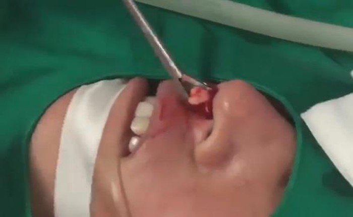 Chiếc răng sau khi được lấy ra khỏi mũi bệnh nhân. Ảnh: Sức Khỏe Đời Sống.