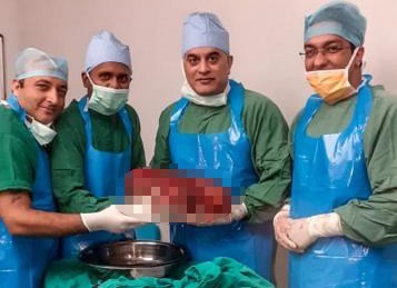Các bác sĩ chụp ảnh cùng quả thận nặng 7,4kg. Ảnh: Bệnh viện Sir Ganga Ram.