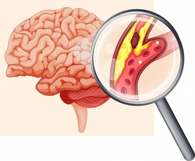 Cục máu đông, nguyên nhân hàng đầu gây tai biến mạch máu não.