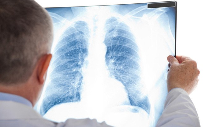 Ung thư phổi: Sàng lọc sớm hiệu quả điều trị cao