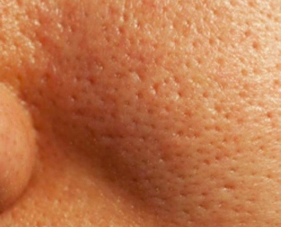 Vì sao lỗ chân lông trên da mặt càng ngày càng to?