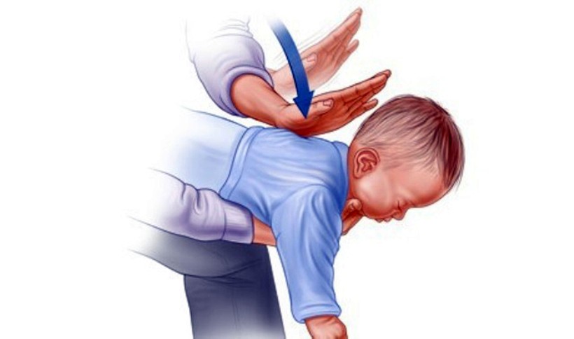 Thủ thuật vỗ lưng khi trẻ bị hóc dị vật
