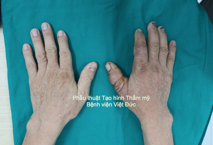 Ngón cái bàn tay phải của bệnh nhân hoàn toàn khỏe mạnh sau 5 tuần phẫu thuật.