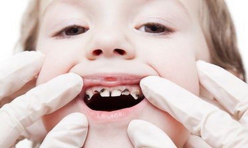 Rối loạn mọc răng vĩnh viễn ở trẻ em (minh họa).