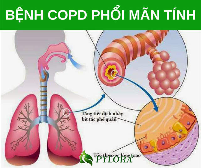 Bệnh phổi tắc nghẽn mãn tính (COPD): Dấu hiệu và cách phòng tránh (Ảnh MH).