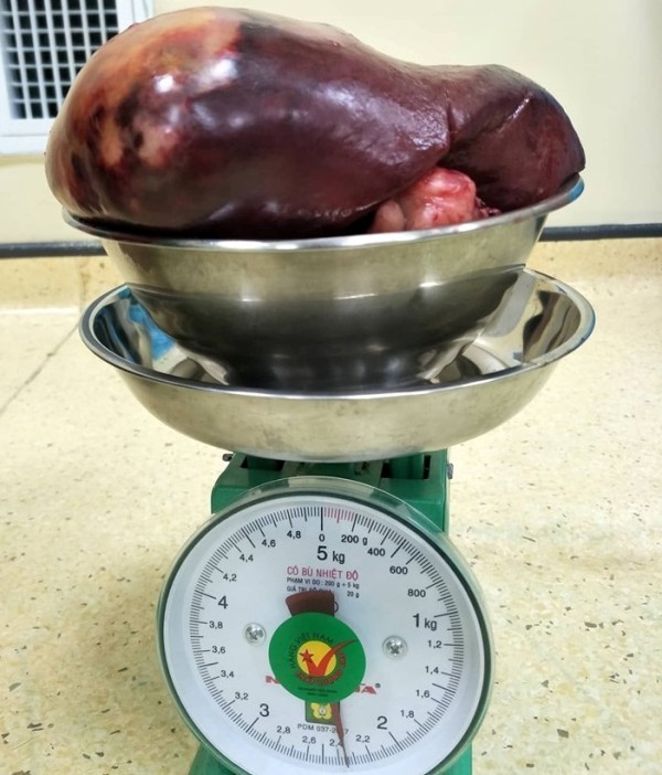 Khối u lách nặng 2,3kg được lấy ra khỏi cơ thể  người bệnh.