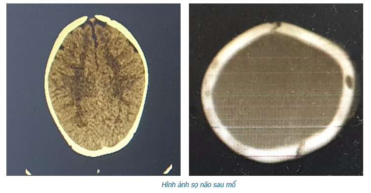 Hình ảnh sọ não sau khi phẫu thuật (BVCC).