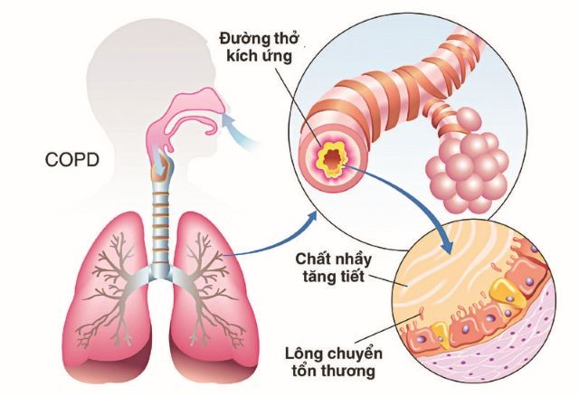 Bệnh phổi tắc nghẽn mạn tính: ảnh hưởng tới chất lượng cuộc sống.